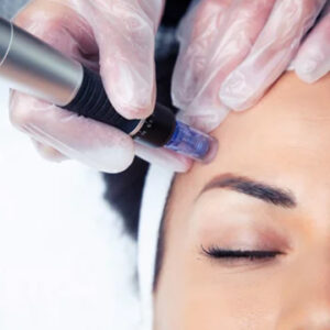 Dermapen Facial